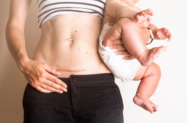Sau sinh mổ bao lâu thì hồi phục?